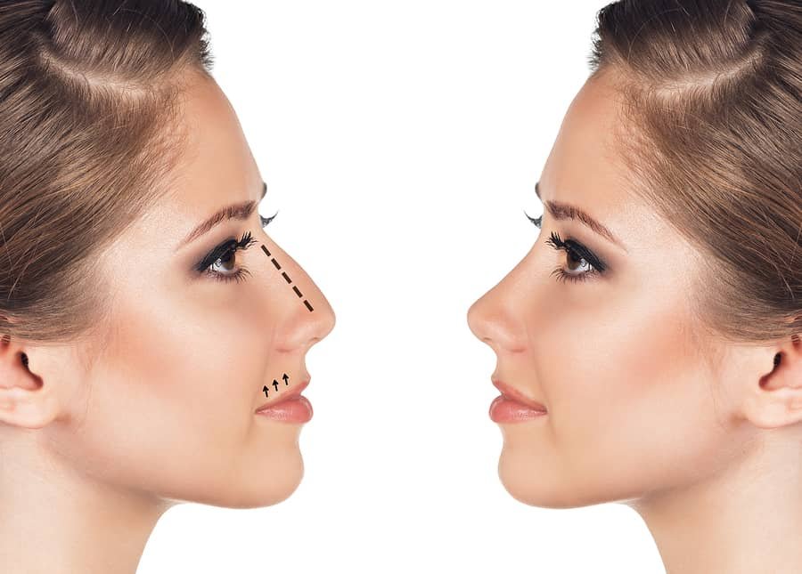 Mediyatra Nasal Septal Reconstruction