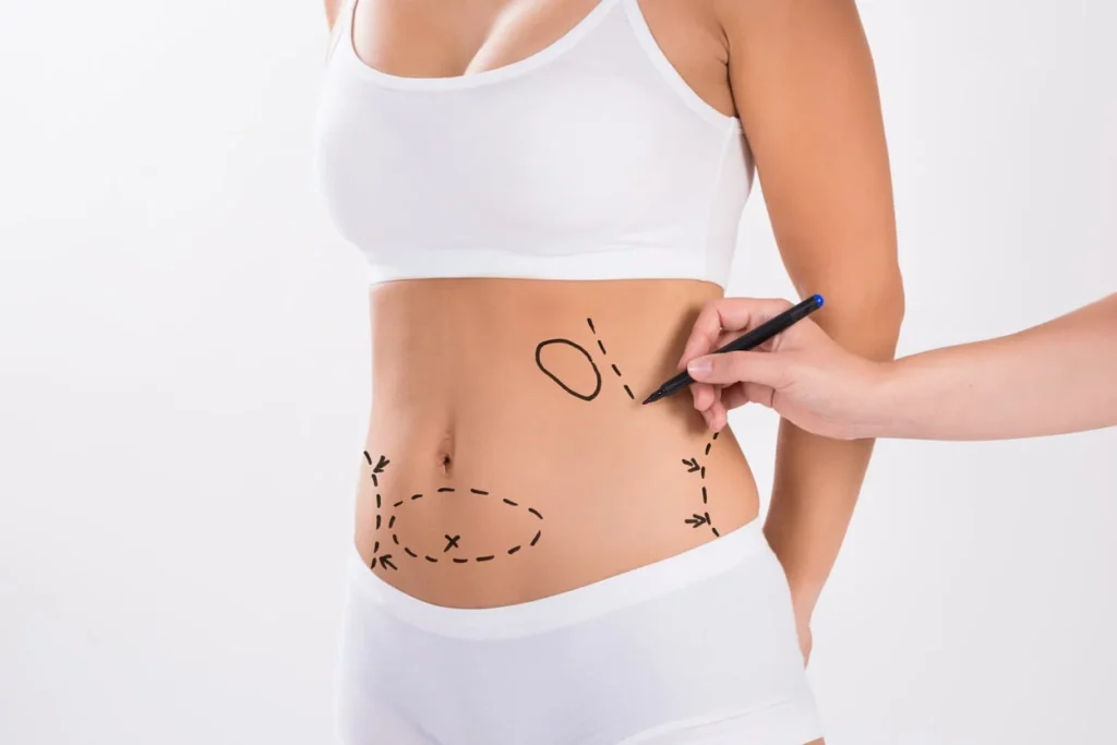 Mediyatra Liposuction