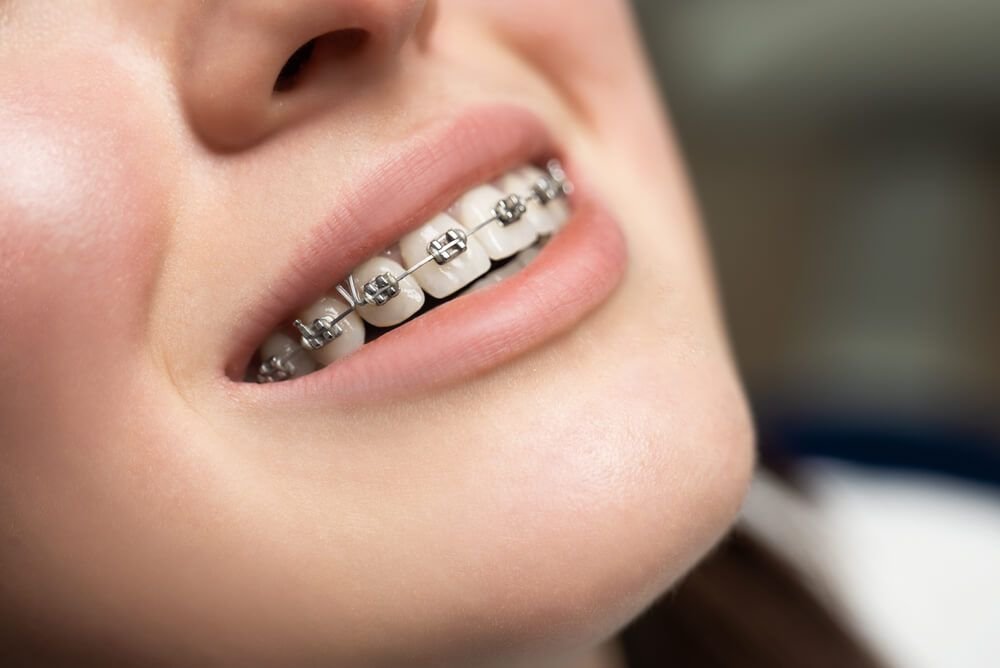 Mediyatra Braces