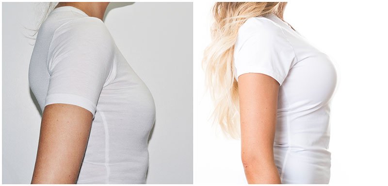 Mediyatra Breast Lift