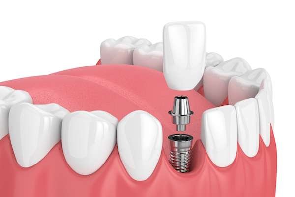 Mediyatra Dental Implant