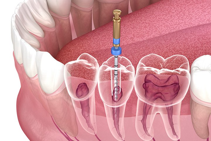 Mediyatra Root canal