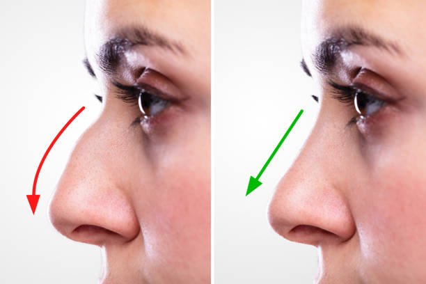 Mediyatra Rhinoplasty