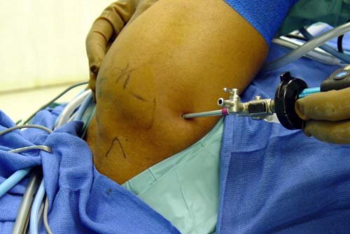Mediyatra Shoulder Arthroscopy