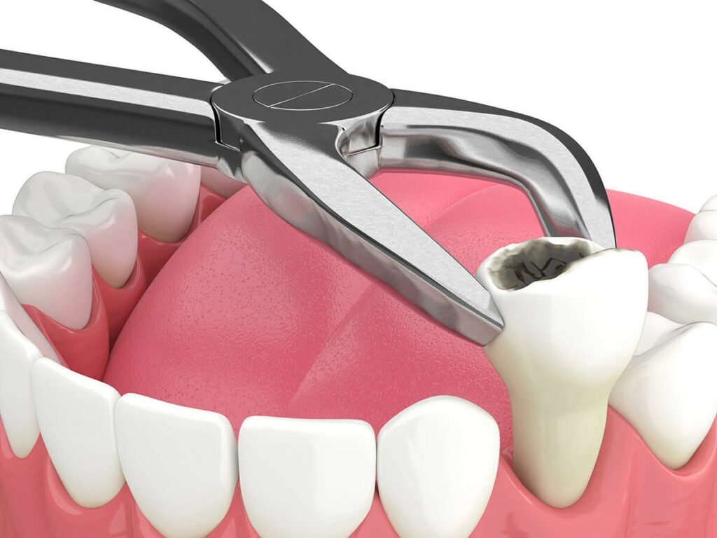 Mediyatra Tooth Extraction