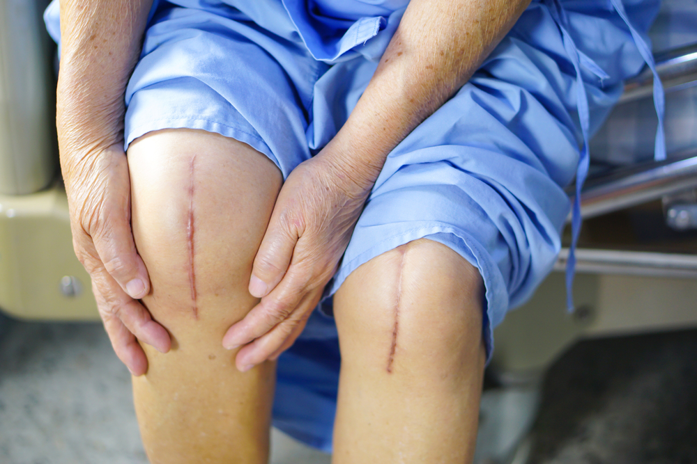 Mediyatra knee Replacement