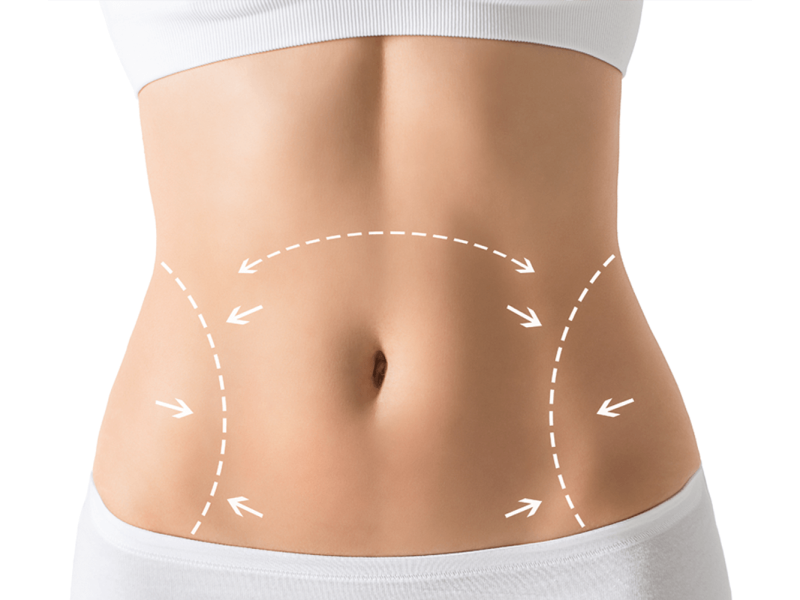 Mediyatra Tummy Tuck (Abdominoplasty)
